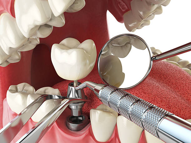 Best Emergency Dentist for Lost Fillings or Crowns in Quinlan, TX